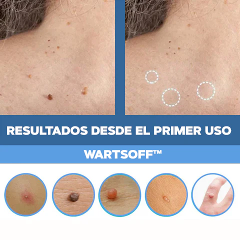 WART-QUITA VERRUGAS